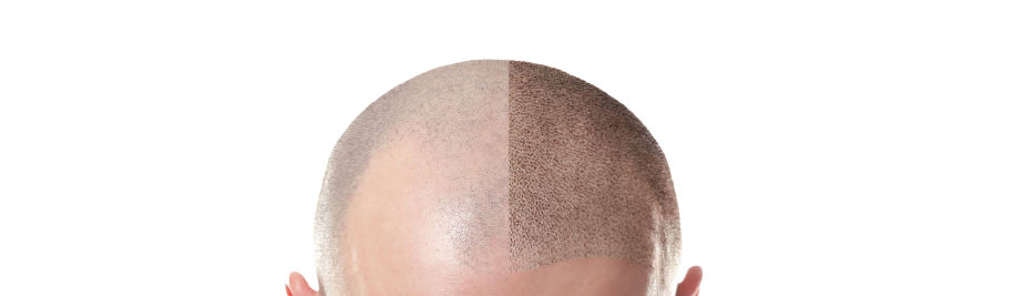 Antes e depois do transplante capilar
